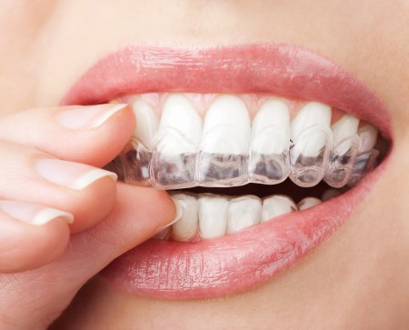 teeth grinding treatment braces