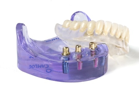 Denture Stabilization Procedure